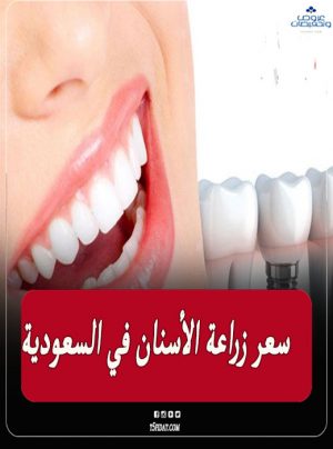 سعر زراعة الأسنان في السعودية 2022 وأفضل المراكز الطبية في الرياض