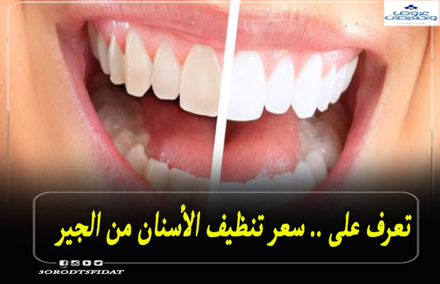 سعر تنظيف الأسنان من الجير 2022 في السعودية ومصر