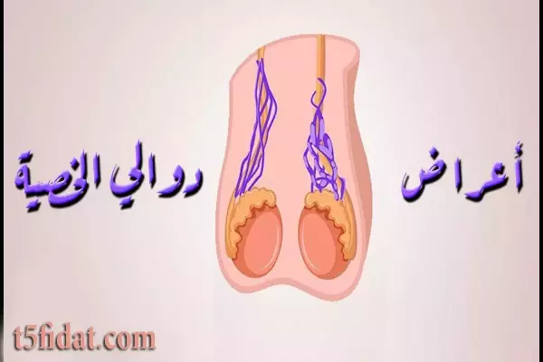 تكلفة عملية دوالي الخصية